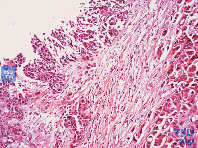 输尿管浸润性高级别尿路上皮癌，伴腺样分化，黏膜表层为经典的尿路上皮癌，深部呈腺样分化