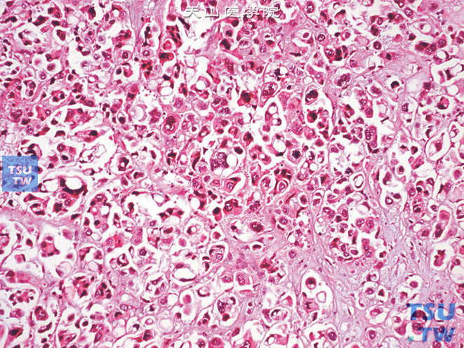 输尿管浸润性高级别尿路上皮癌，伴腺样分化，可见腺管样结构及印戒样细胞