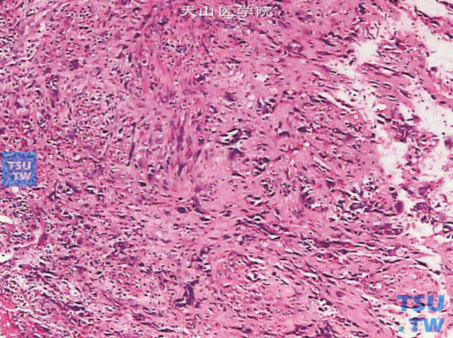输尿管鳞癌，伴肉瘤样分化，示肉瘤样分化区细胞呈梭形