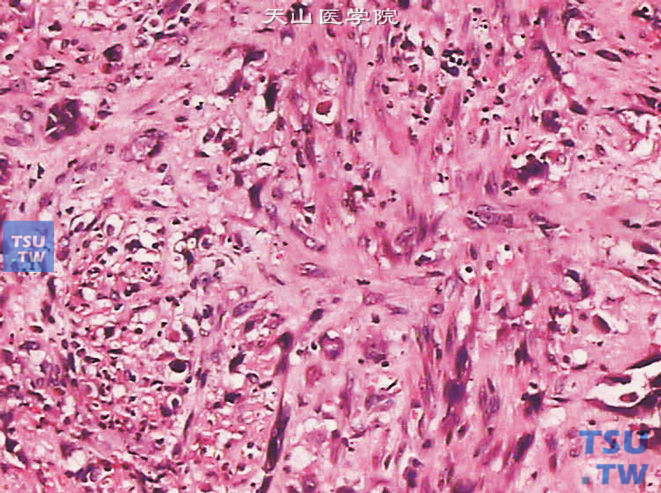 输尿管鳞癌，伴肉瘤样分化，可见异型性明显的梭形细胞