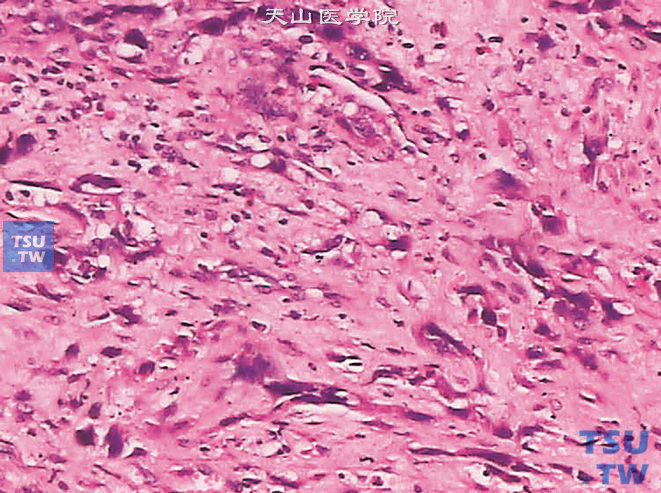 输尿管鳞癌，伴肉瘤样分化，示核异型性及明显的核仁
