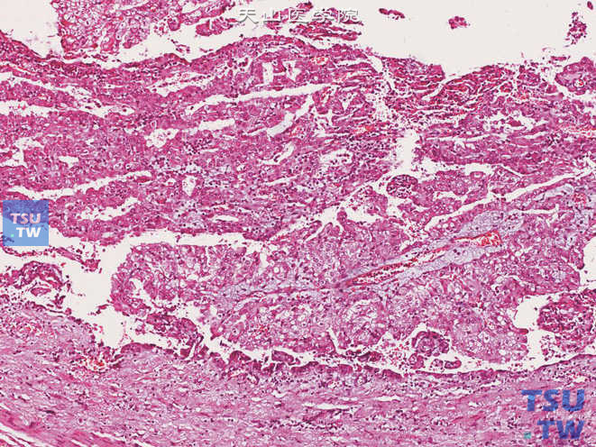输尿管腺癌病理图谱