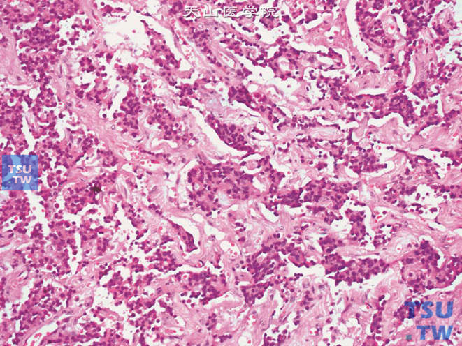 输尿管类癌肿瘤细胞胞质丰富，双嗜色性，细胞异型性不明显，核染色质细颗粒状