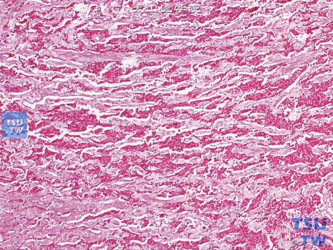 输尿管类癌，肿瘤细胞在富含血管的间质中排列成岛状或小梁状