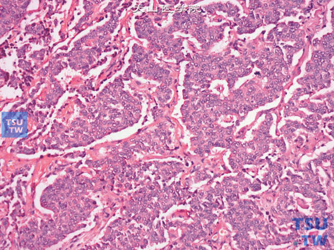 输尿管类癌，部分区域肿瘤细胞排列成假腺样结构，核染色质呈细颗粒状，核仁不明显