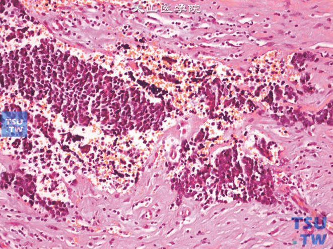 输尿管小细胞癌，示燕麦细胞