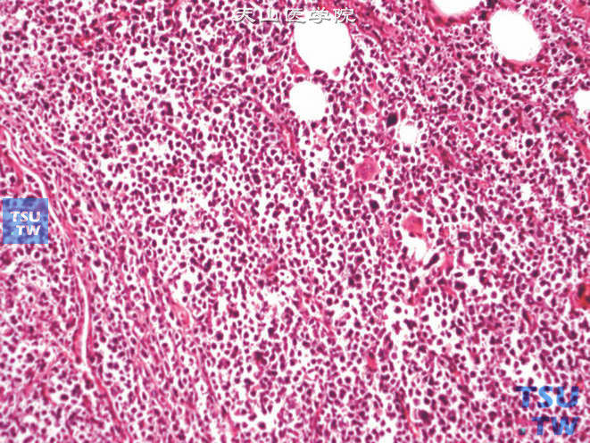 输尿管下段淋巴瘤，可见瘤细胞弥漫浸润
