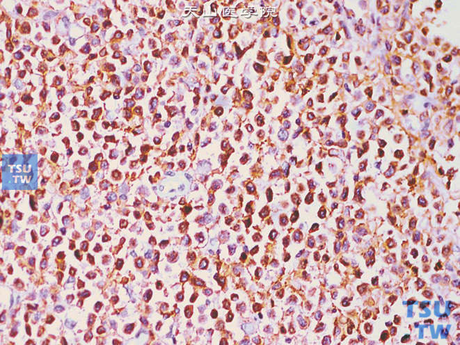 输尿管下段淋巴瘤，免疫组化：CD79a（+）