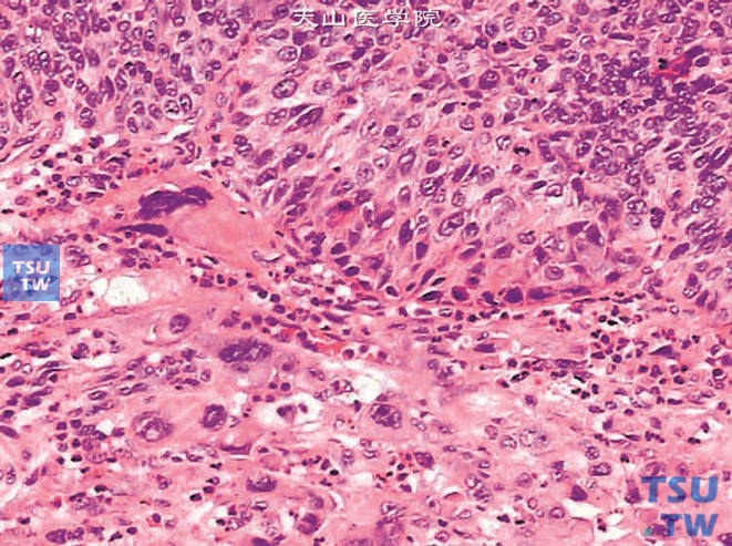 输尿管癌肉瘤，示核异型性明显