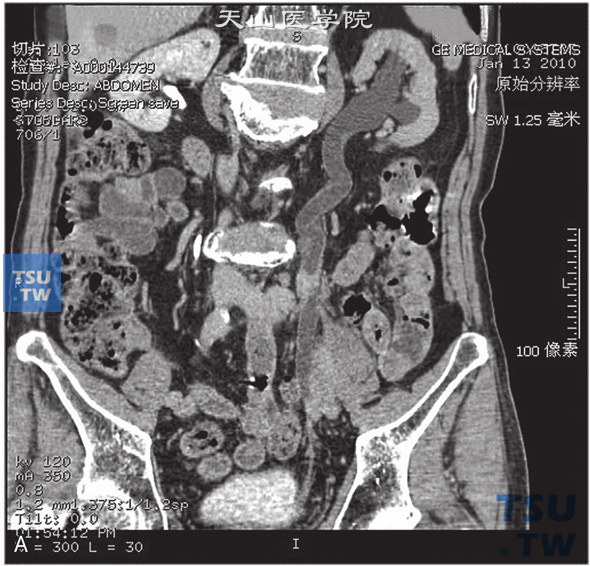 上图A：CT，输尿管转移瘤。男，66岁，乙状结肠癌术后3年，左肾积水，左输尿管中段远端管腔内见软组织密度灶，增强后动脉期及门脉期逐渐强化，重建图像可见左肾积水