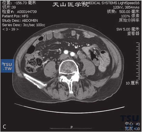 上图C：CT，输尿管转移瘤。男，66岁，乙状结肠癌术后3年，左肾积水，左输尿管中段远端管腔内见软组织密度灶，增强后动脉期及门脉期逐渐强化，重建图像可见左肾积水