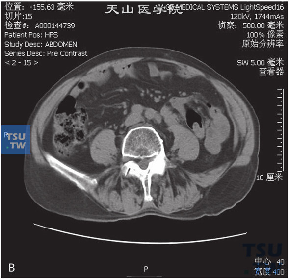 上图D：CT，输尿管转移瘤。男，66岁，乙状结肠癌术后3年，左肾积水，左输尿管中段远端管腔内见软组织密度灶，增强后动脉期及门脉期逐渐强化，重建图像可见左肾积水
