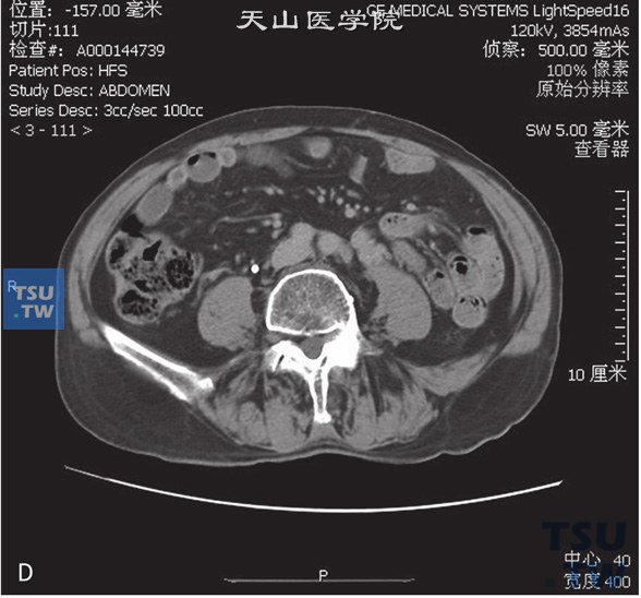 上图D：CT，输尿管转移瘤。男，66岁，乙状结肠癌术后3年，左肾积水，左输尿管中段远端管腔内见软组织密度灶，增强后动脉期及门脉期逐渐强化，重建图像可见左肾积水