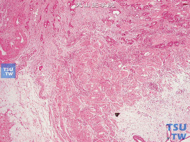 输尿管转移性胆囊腺癌，肿瘤位于肌层（右下角为黏膜组织）