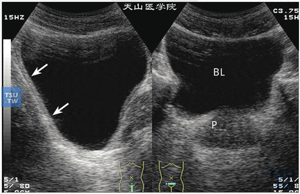 膀胱正常结构超声图像特点：适度充盈的膀胱在声像图中是一个囊状结构，囊壁即膀胱壁，囊腔即膀胱腔，膀胱腔是一片无回声暗区，透声性良好，均匀一致。充盈后的膀胱壁薄而光滑，厚度约2～3mm，（箭头指示，P：代表前列腺）