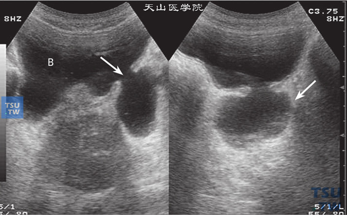 膀胱憩室超声图像特点：膀胱憩室是膀胱局部袋状外凸的表现，在声像图中可见膀胱近旁有另外的囊状回声，囊腔大小不一，单发或多发，轮廓清晰，与膀胱有开口。左侧箭头指示膀胱憩室与膀胱有开口，右侧箭头指示憩室的囊腔
