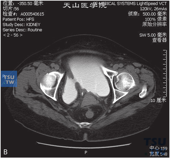 图B：膀胱憩室伴憩室内移行上皮癌。女，66岁，体检发现膀胱肿瘤。CT提示膀胱右侧壁囊状凸起，与膀胱腔相交通，前壁稍厚，增强后可见强化，分泌期可见对比剂进入，前壁可见结节状充盈缺损