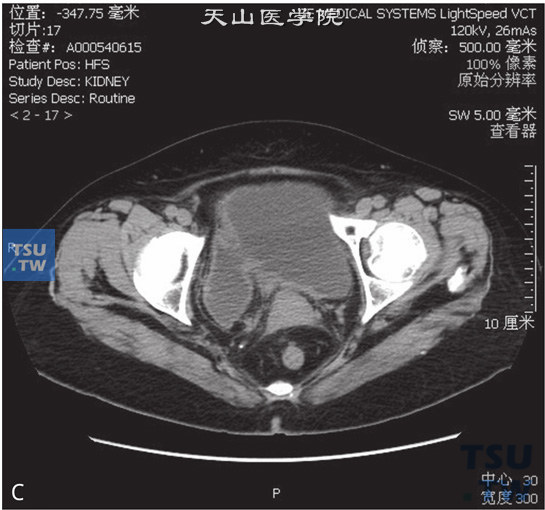 图C：膀胱憩室伴憩室内移行上皮癌。女，66岁，体检发现膀胱肿瘤。CT提示膀胱右侧壁囊状凸起，与膀胱腔相交通，前壁稍厚，增强后可见强化，分泌期可见对比剂进入，前壁可见结节状充盈缺损