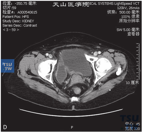 图D：膀胱憩室伴憩室内移行上皮癌。女，66岁，体检发现膀胱肿瘤。CT提示膀胱右侧壁囊状凸起，与膀胱腔相交通，前壁稍厚，增强后可见强化，分泌期可见对比剂进入，前壁可见结节状充盈缺损