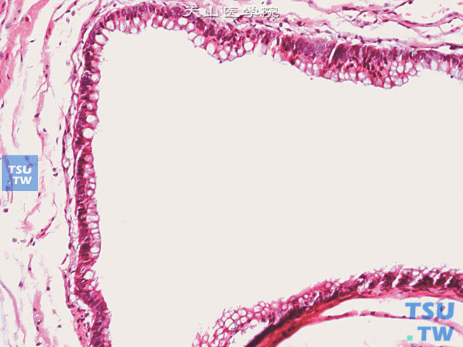 膀胱壁内脐尿管残余，示脐尿管上皮肠上皮化生，可见杯状细胞