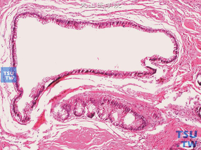 膀胱壁内脐尿管残余，可见肠上皮化生