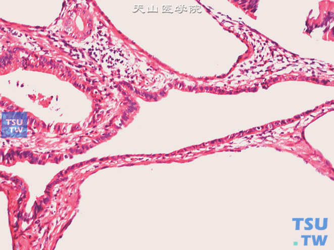 膀胱壁内脐尿管残余，被覆上皮呈扁平、矮立方或柱状