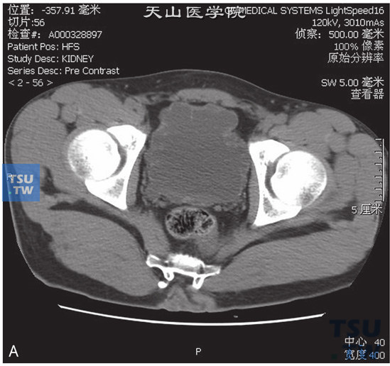 图A：CT，间质性膀胱炎。男，63岁，尿频。尿痛；膀胱形态不规则，膀胱壁略增厚，可见多发小囊状灶轻度凸出于膀胱壁，分泌期可见对比剂充盈。3D重建图像可见双侧肾盂、肾盏及输尿管扩张