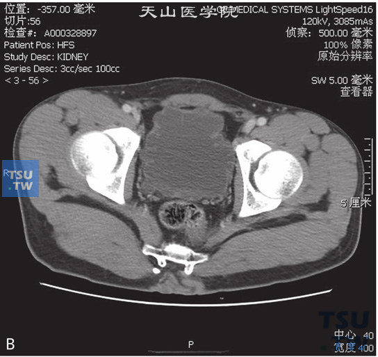 图B：CT，间质性膀胱炎。男，63岁，尿频。尿痛；膀胱形态不规则，膀胱壁略增厚，可见多发小囊状灶轻度凸出于膀胱壁，分泌期可见对比剂充盈。3D重建图像可见双侧肾盂、肾盏及输尿管扩张