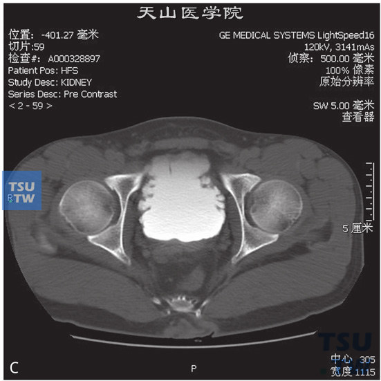 图C：CT，间质性膀胱炎。男，63岁，尿频。尿痛；膀胱形态不规则，膀胱壁略增厚，可见多发小囊状灶轻度凸出于膀胱壁，分泌期可见对比剂充盈。3D重建图像可见双侧肾盂、肾盏及输尿管扩张