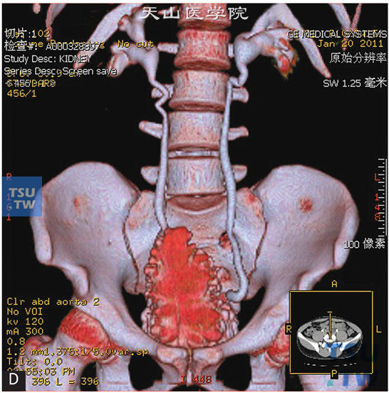 图D：CT，间质性膀胱炎。男，63岁，尿频。尿痛；膀胱形态不规则，膀胱壁略增厚，可见多发小囊状灶轻度凸出于膀胱壁，分泌期可见对比剂充盈。3D重建图像可见双侧肾盂、肾盏及输尿管扩张