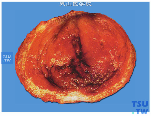 间质性膀胱炎（大体）。膀胱黏膜常并发溃疡（Hunter溃疡）