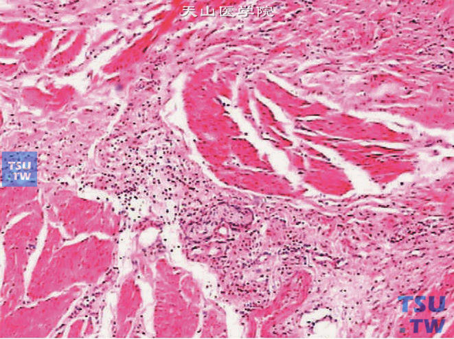 间质性膀胱炎，肌层内有炎细胞浸润