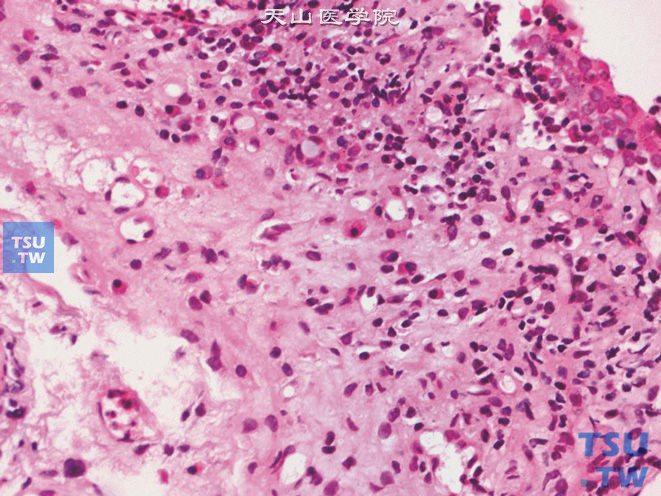 间质性膀胱炎，可见淋巴细胞，浆细胞，肥大细胞及嗜酸性粒细胞
