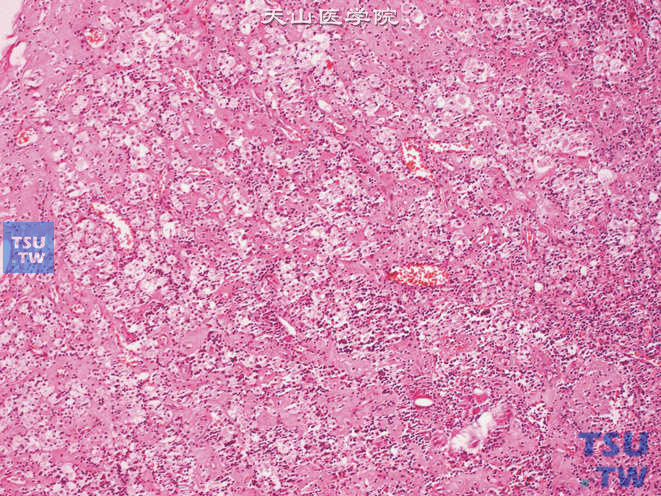 黄色肉芽肿性膀胱炎，可见大量泡沫细胞，伴有淋巴细胞及多核巨细胞