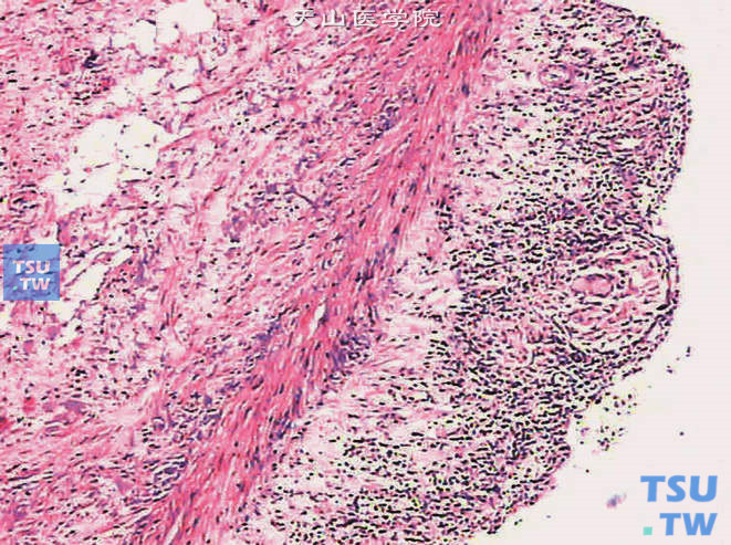 膀胱BCG灌注后反应，黏膜层可见淋巴细胞及多核巨细胞