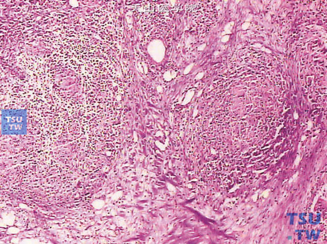 膀胱BCG灌注后反应，可见由淋巴细胞、上皮样细胞及多核巨细胞构成的肉芽肿性炎性结节