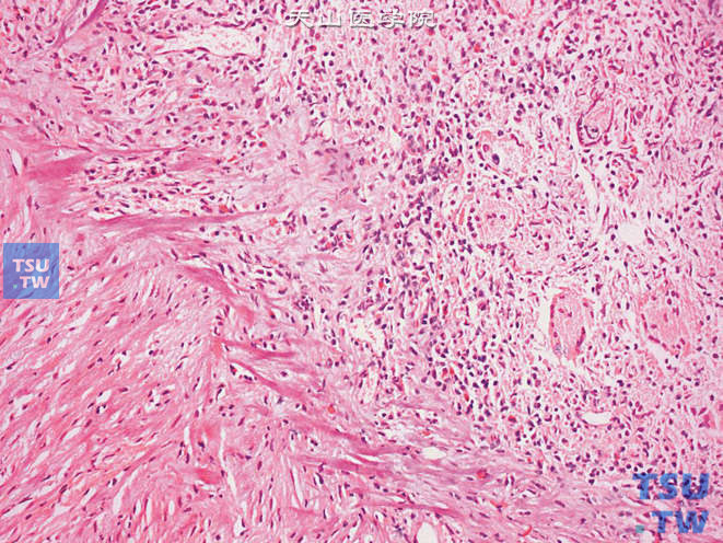 膀胱BCG灌注治疗后反应，可见伴多核巨细胞的肉芽肿性结节