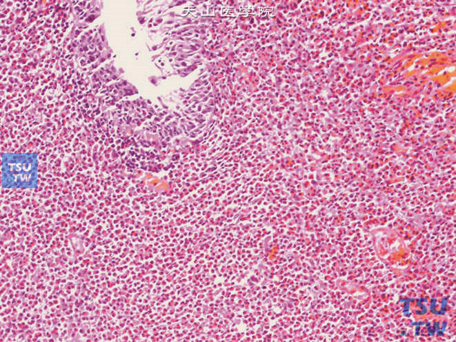 嗜酸细胞性膀胱炎，示黏膜层大量嗜酸性粒细胞浸润（上图高倍）