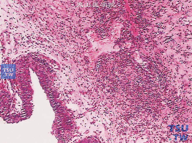 嗜酸细胞性膀胱炎病理图谱