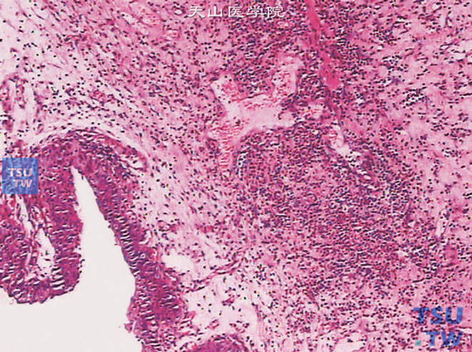 嗜酸细胞性膀胱炎，示黏膜固有层血管扩张、充血，黏膜水肿，伴大量嗜酸性粒细胞浸润
