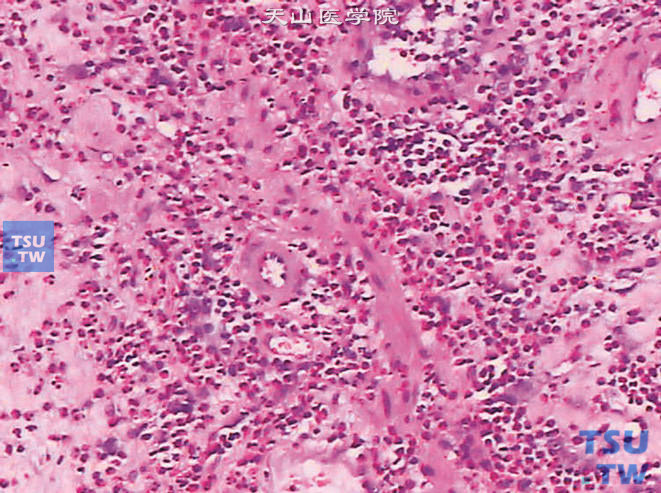 嗜酸细胞性膀胱炎，上图高倍，示大量嗜酸性粒细胞浸润