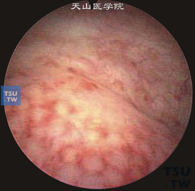 滤泡性膀胱炎（膀胱镜）。黏膜表面出现红斑，并伴有粉红色或灰白色圆顶突起