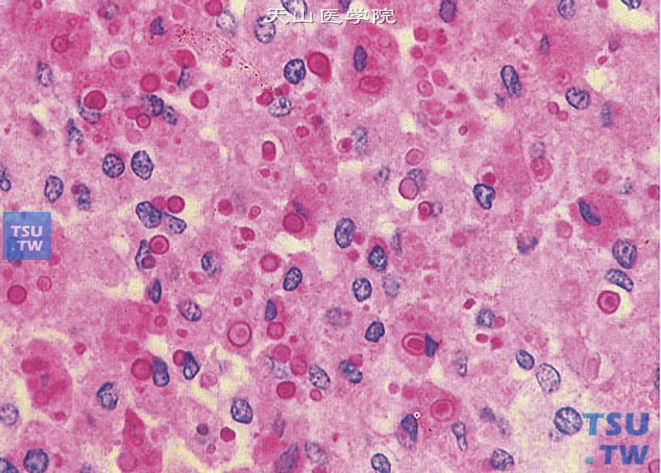 膀胱软斑，PAS染色，示软斑小体（MG小体）