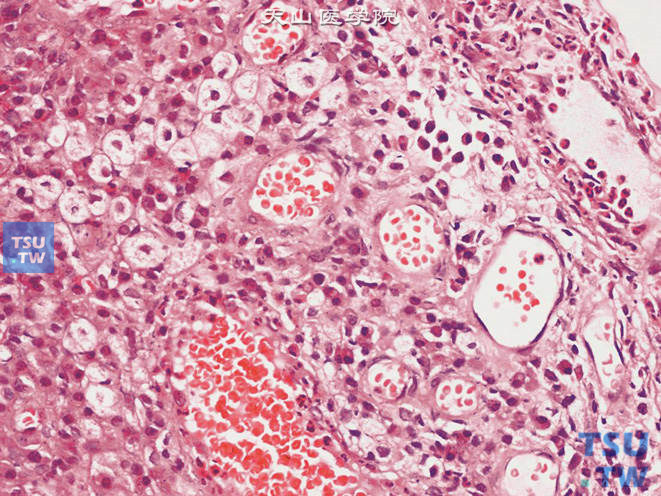 膀胱浆细胞性肉芽肿，示成熟浆细胞与其他炎细胞混合浸润