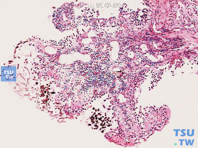 真菌性膀胱炎，可见孢子和假菌丝