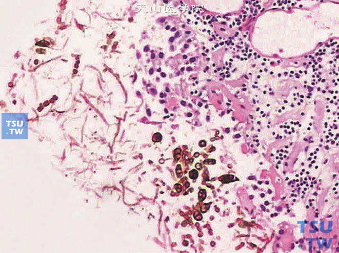 真菌性膀胱炎，上图高倍，示孢子和菌丝