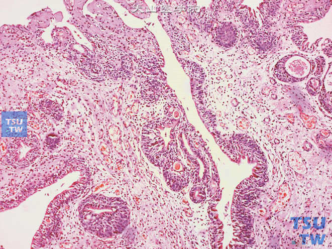 囊性膀胱炎，可见固有层内成巢的尿路上皮团，团中有囊腔，囊腔表面被覆着一层立方细胞或多层尿路上皮，并与Brunn巢同时存在。囊腔内可见粉染物