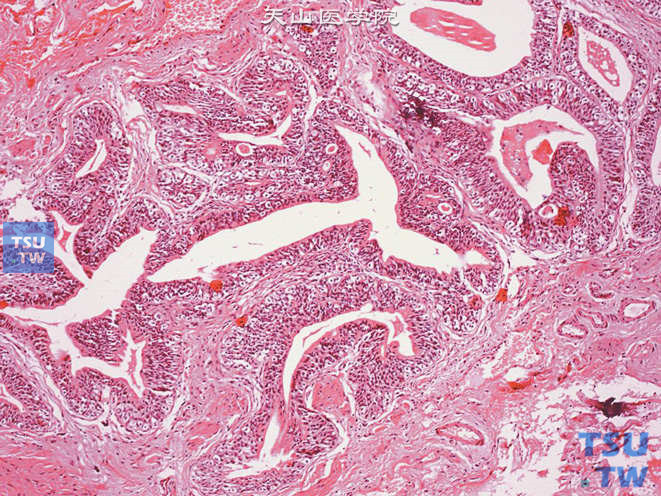 腺性膀胱炎，示腔面上皮呈分泌上皮表现，腔内可见粉染无定形物