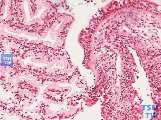 腺性膀胱炎，男24岁，示腺上皮化生，腺腔衬以柱状细胞，外围绕一至数层尿路上皮细胞