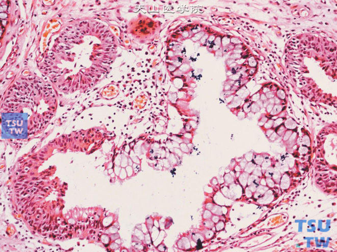 腺性膀胱炎，伴肠腺型化生，示向肠上皮化生移行